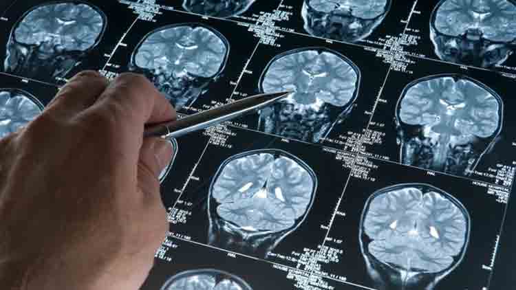 Científicos se unen para combatir a las enfermedades neurodegenerativas